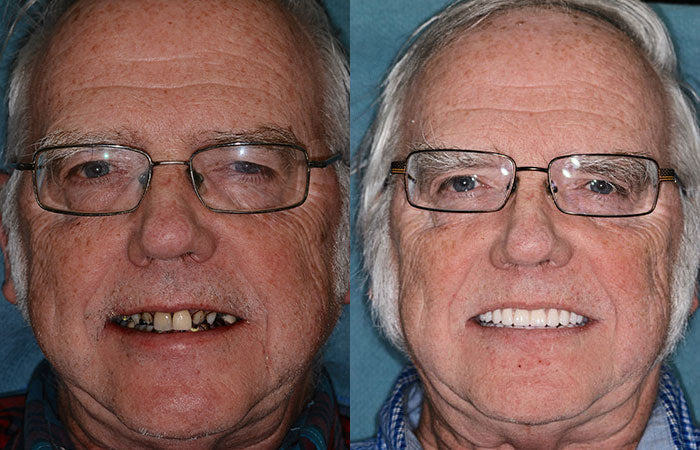 HZA™ –  Individuell angepasstes Vollprothesen-Set