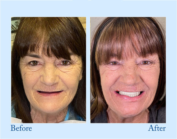 Smileasego™ – Premium Vollprothese für natürliches Lächeln