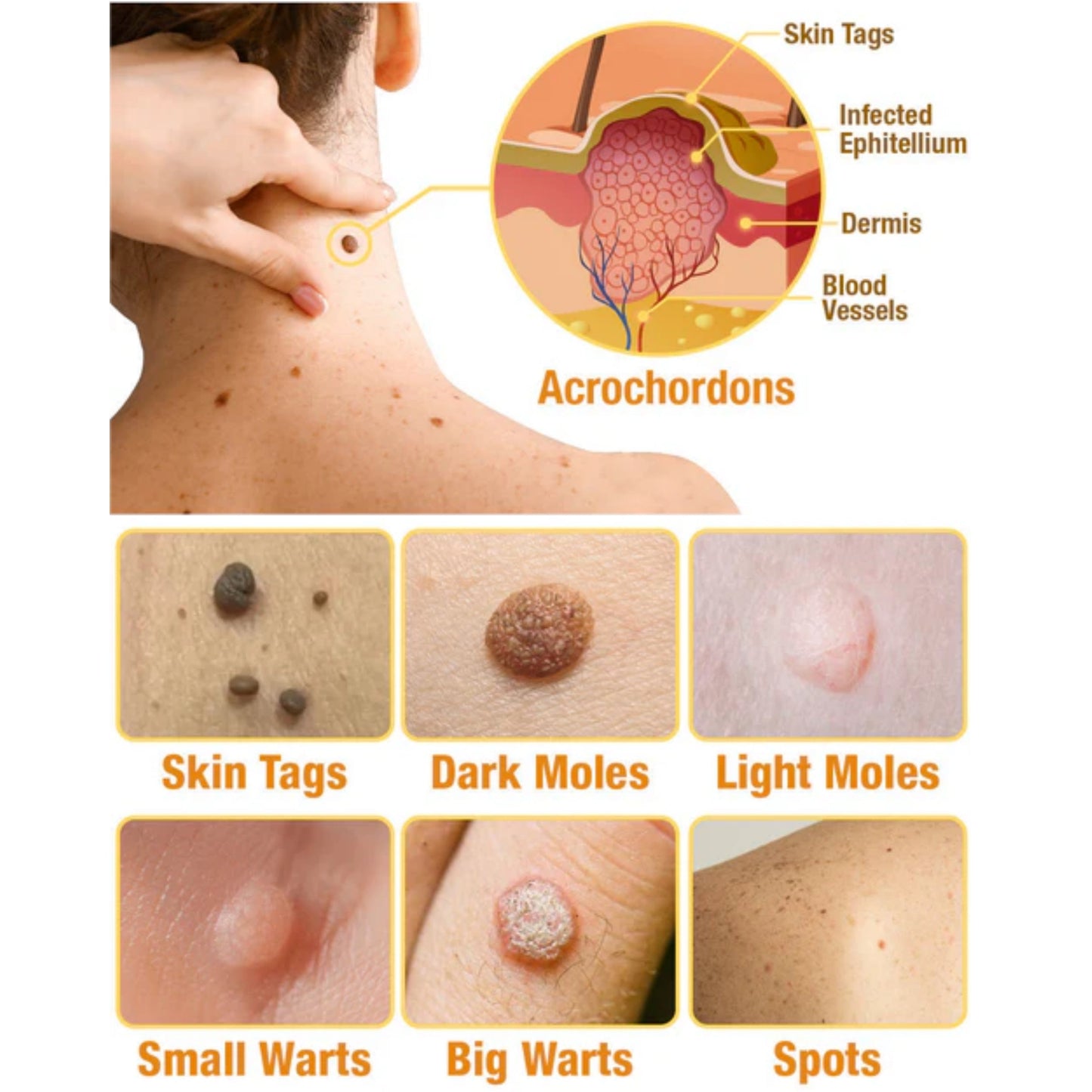 kaufsy | TagAway- Effektive Entfernung von Warzen und Hautwucherungen