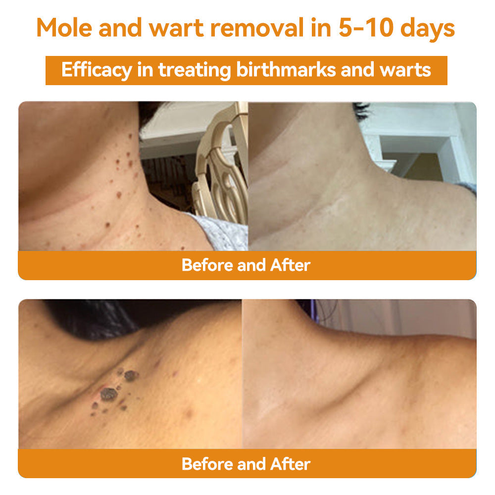 kaufsy | TagAway- Effektive Entfernung von Warzen und Hautwucherungen