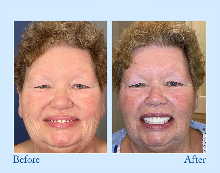 Smileasego™ – Premium Vollprothese für natürliches Lächeln