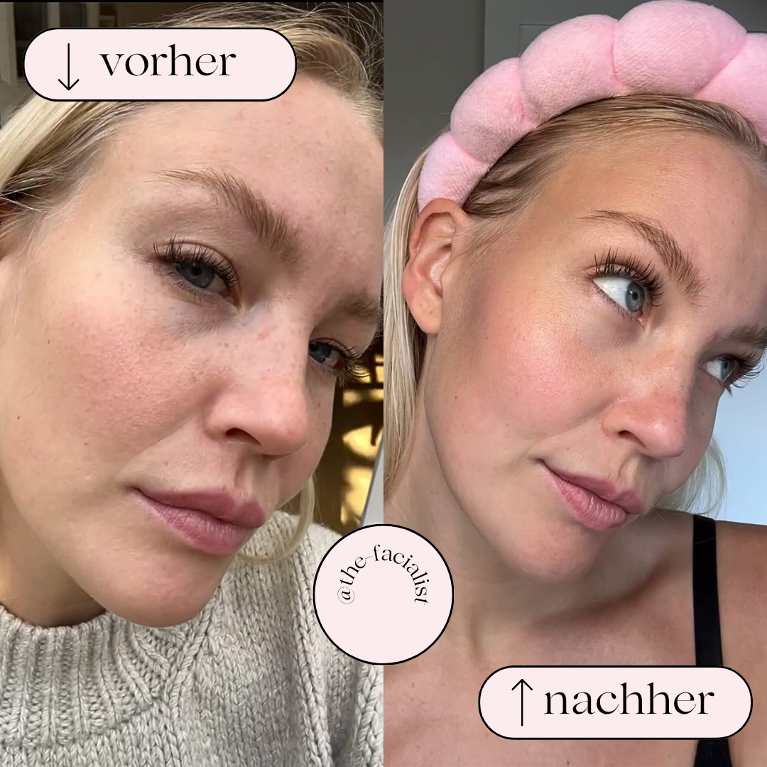 Hydrodermabrasion Porenreiniger – Wasserstoff & Sauerstoff Reinigung