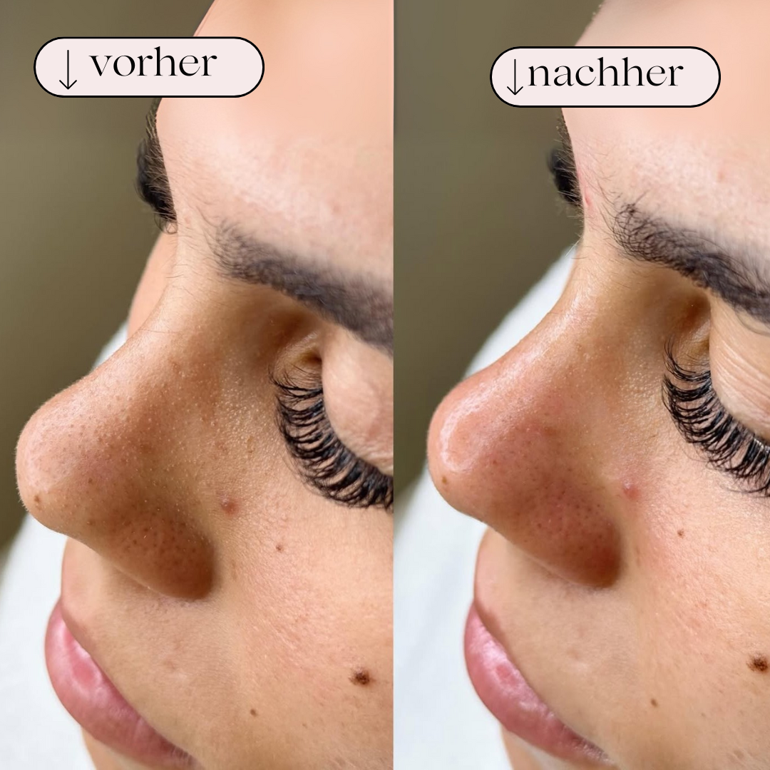 Hydrodermabrasion Porenreiniger – Wasserstoff & Sauerstoff Reinigung