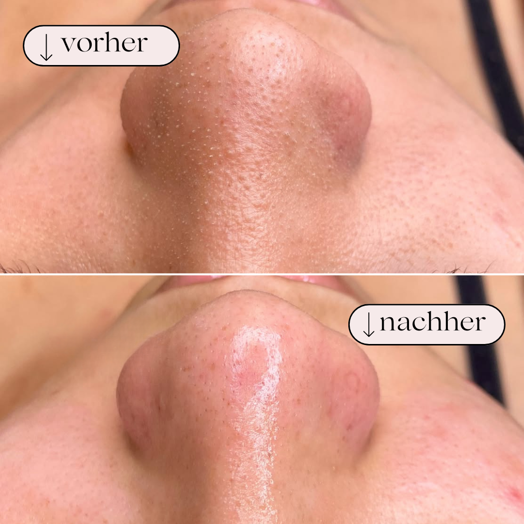 Hydrodermabrasion Porenreiniger – Wasserstoff & Sauerstoff Reinigung