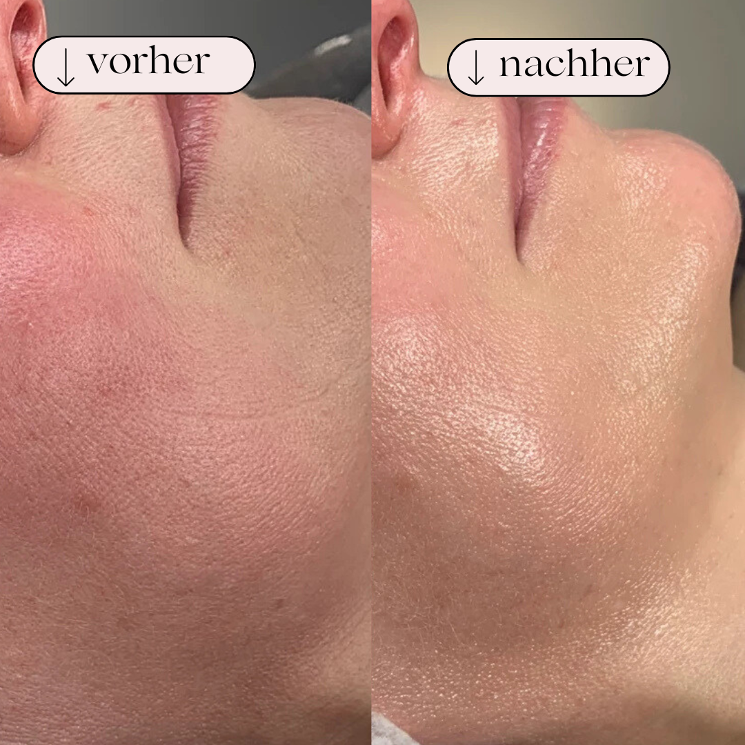 Hydrodermabrasion Porenreiniger – Wasserstoff & Sauerstoff Reinigung