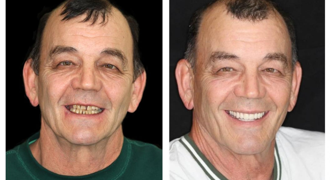 HZA™ –  Individuell angepasstes Vollprothesen-Set