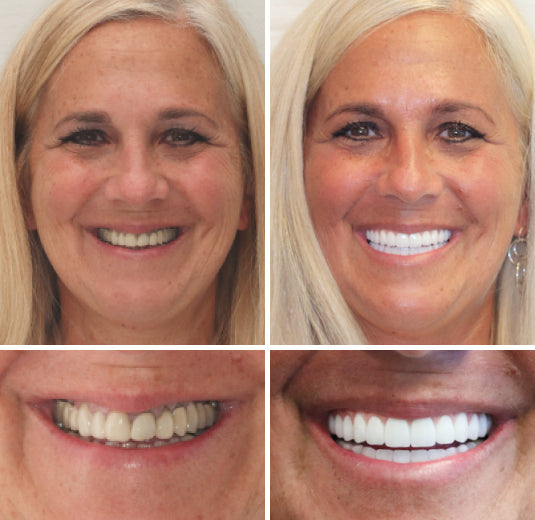 HZA™ –  Individuell angepasstes Vollprothesen-Set